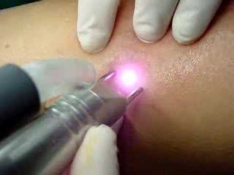 Tratamento de microvarizes: laser transdérmico